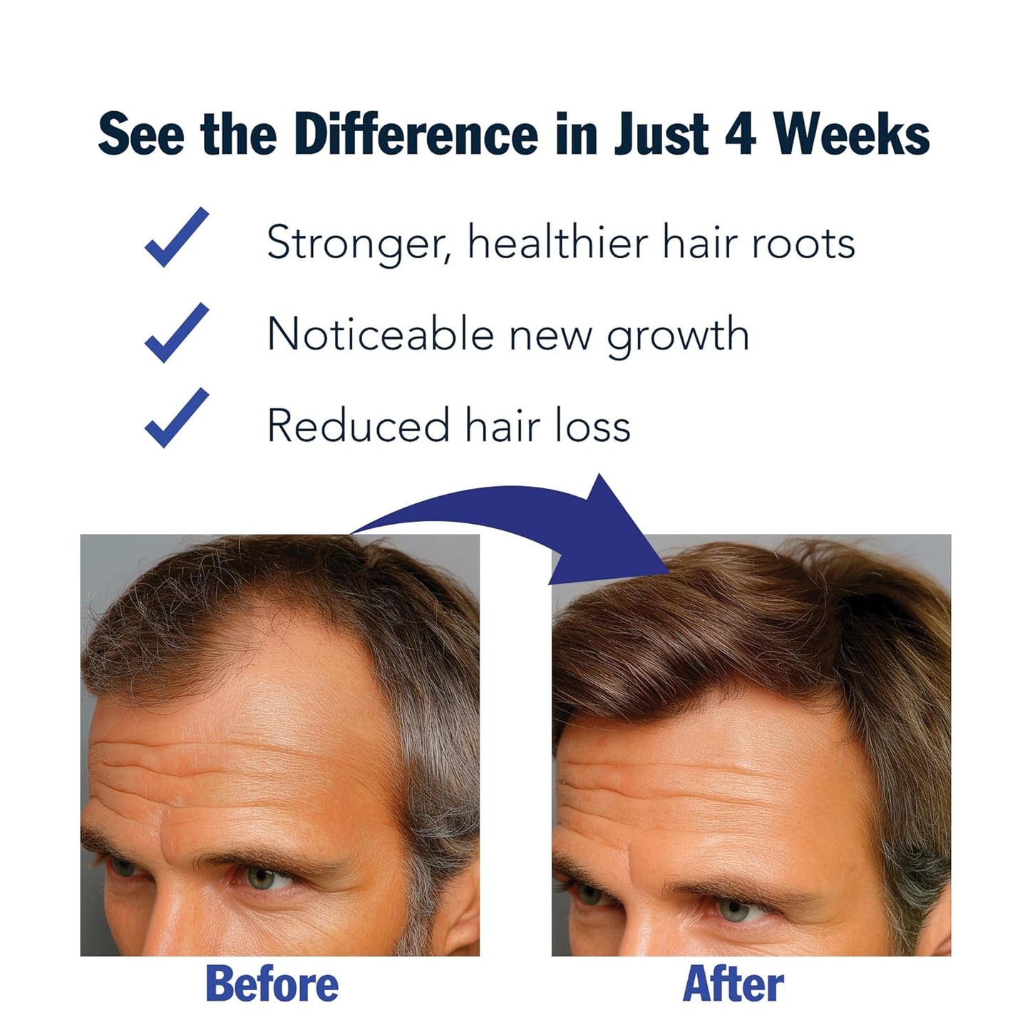 Rosemary Hair Growth Serum Roll-On – 3% Rosemary, 3% Redensyl, DHT